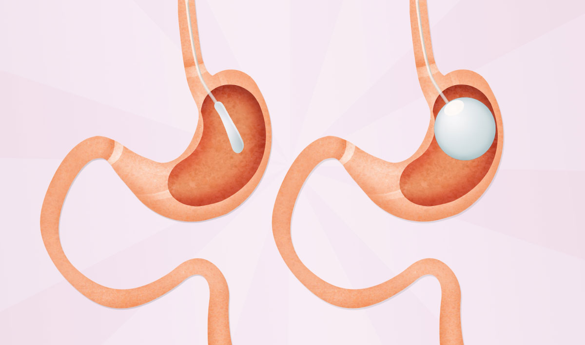 Gastric Balloon – Op. Dr. Çağlar Ertekin